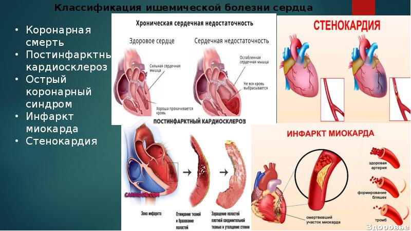 Презентация ишемия сердца