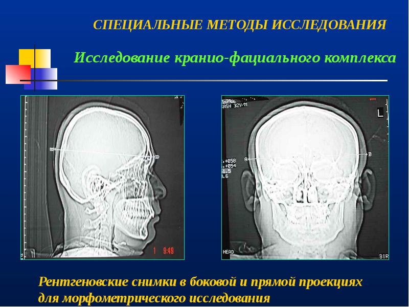 Врожденная патология кранио фациальной области презентация