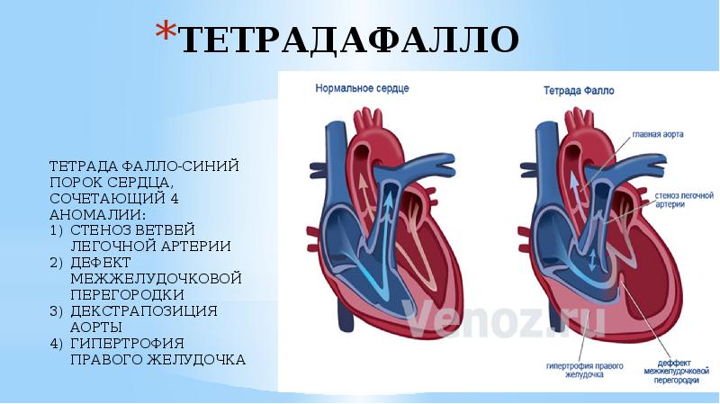 Сердечная система у детей