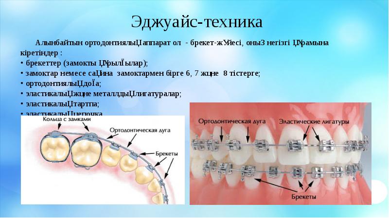 Презентация про брекеты