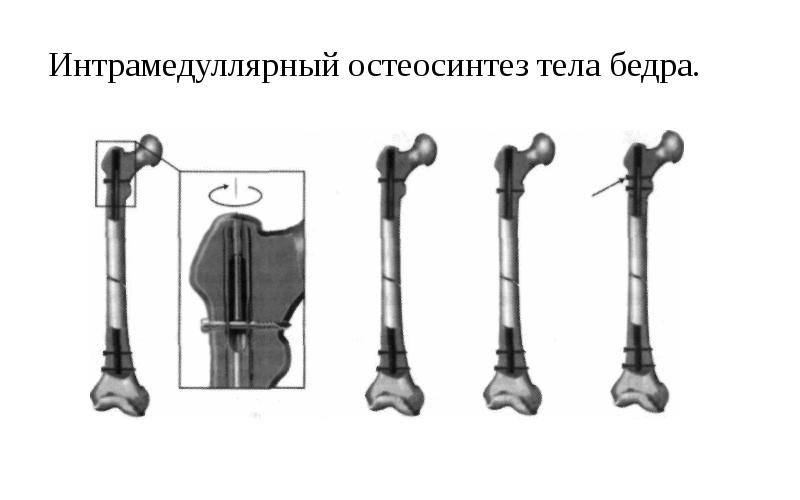 Внеочаговый остеосинтез презентация