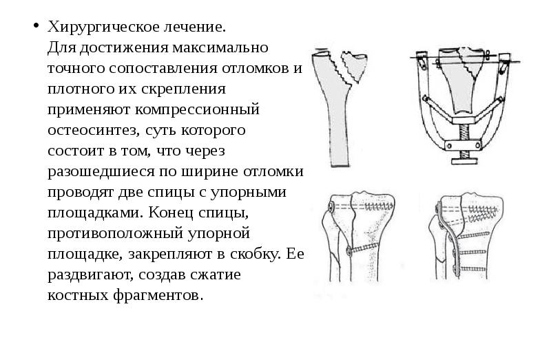 Переломы верхних конечностей презентация