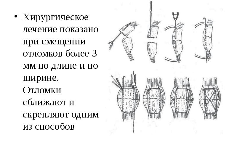 Повреждения нижних конечностей презентация