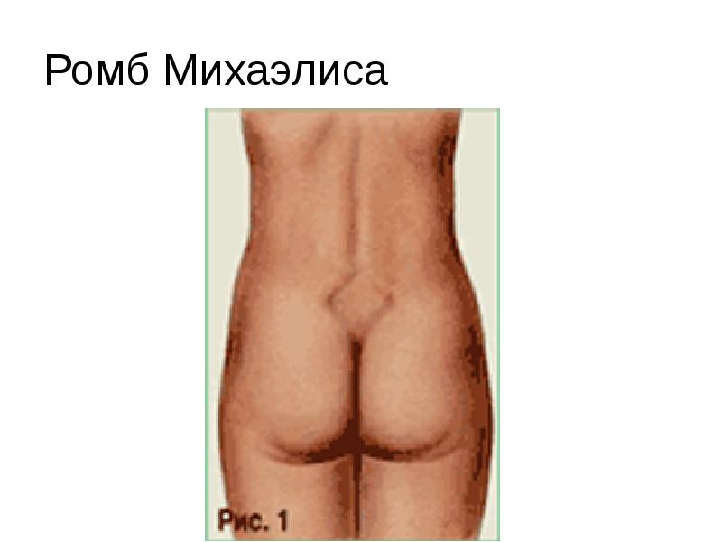 Ромб Михаэлиса