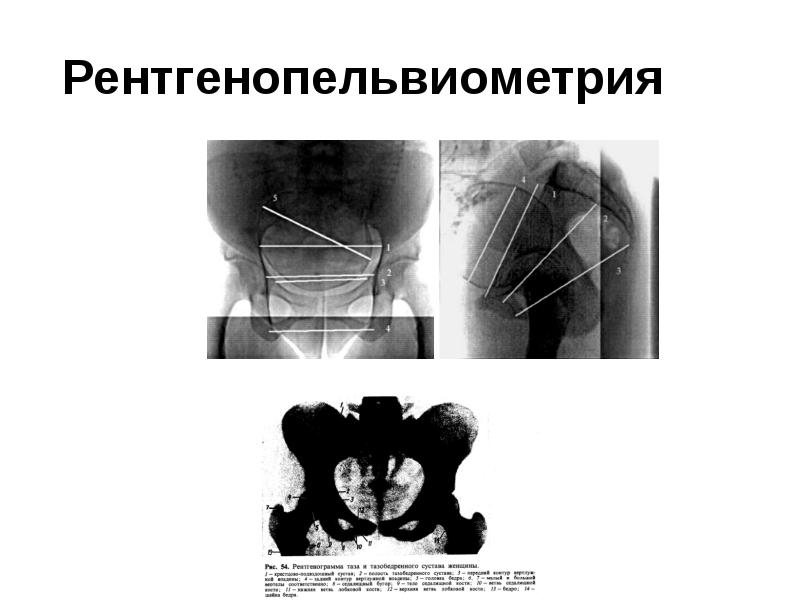 Рентгенопельвиометрия