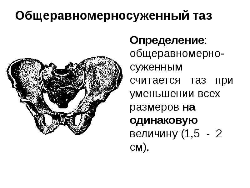 Общеравномерносуженный таз Определение: общеравномерно-суженным  считается  таз  при уменьшении