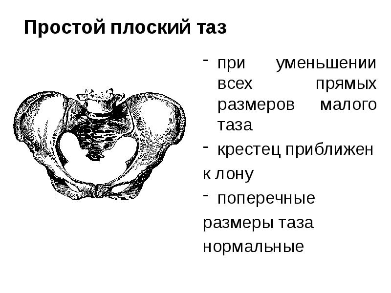 Простой плоский таз при уменьшении всех прямых размеров малого таза 