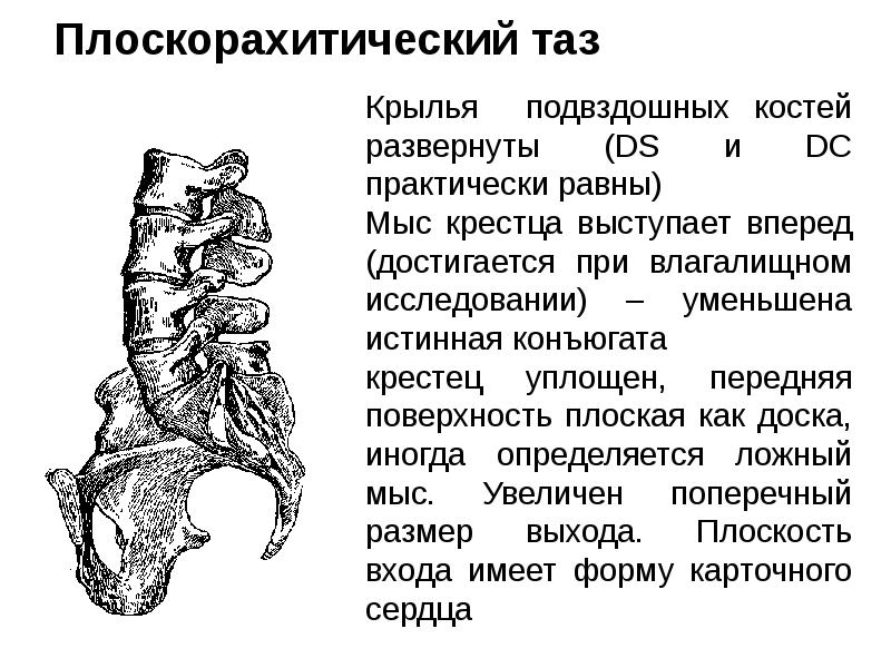 Плоскорахитический таз Крылья подвздошных костей развернуты (DS и DC практически равны)
