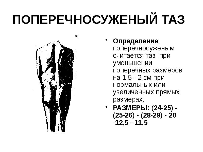 ПОПЕРЕЧНОСУЖЕНЫЙ ТАЗ Определение: поперечносуженым считается таз при уменьшении поперечных размеров на