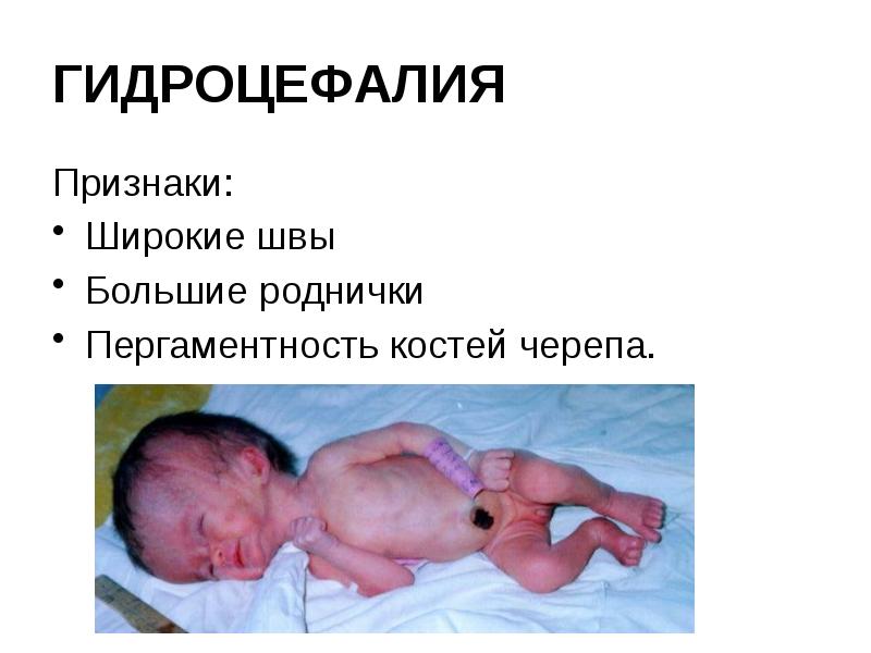 ГИДРОЦЕФАЛИЯ Признаки: Широкие швы Большие роднички Пергаментность костей черепа.