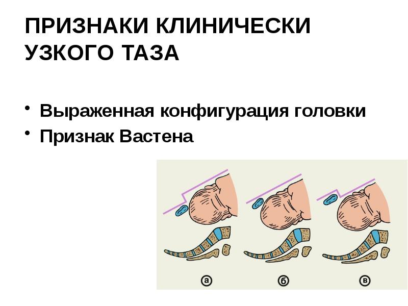 ПРИЗНАКИ КЛИНИЧЕСКИ УЗКОГО ТАЗА  Выраженная конфигурация головки Признак Вастена