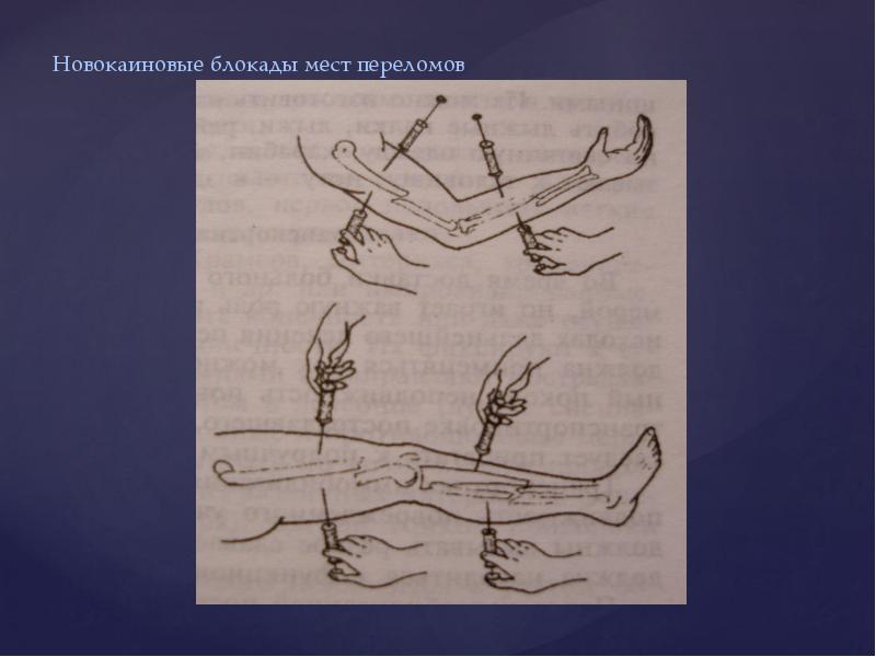 Блокады при переломах. Футлярная блокада места перелома. Новокаиновая блокада зон переломов.