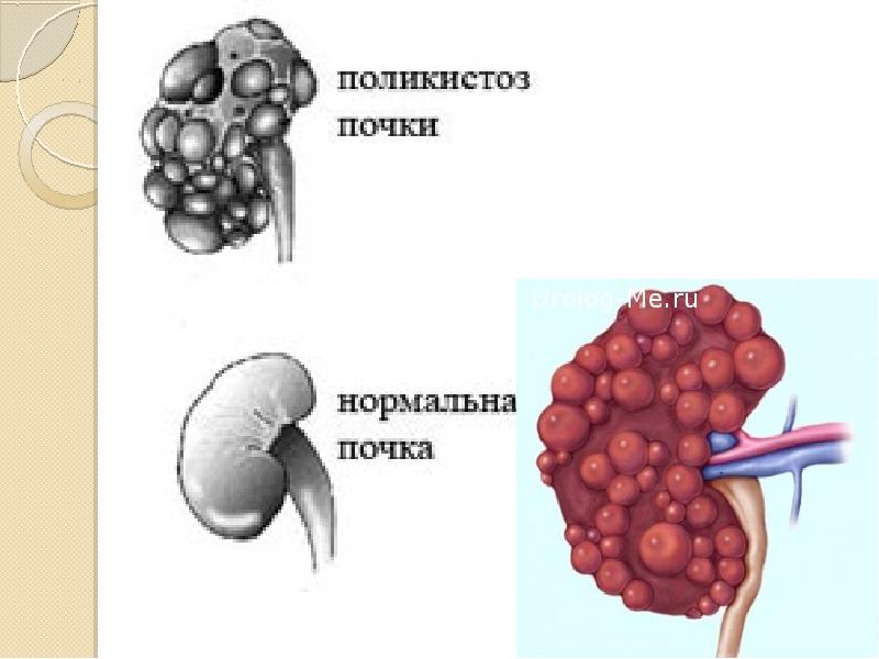 Мультикистозная почек плода. Мультикистоз и поликистоз почек отличие.
