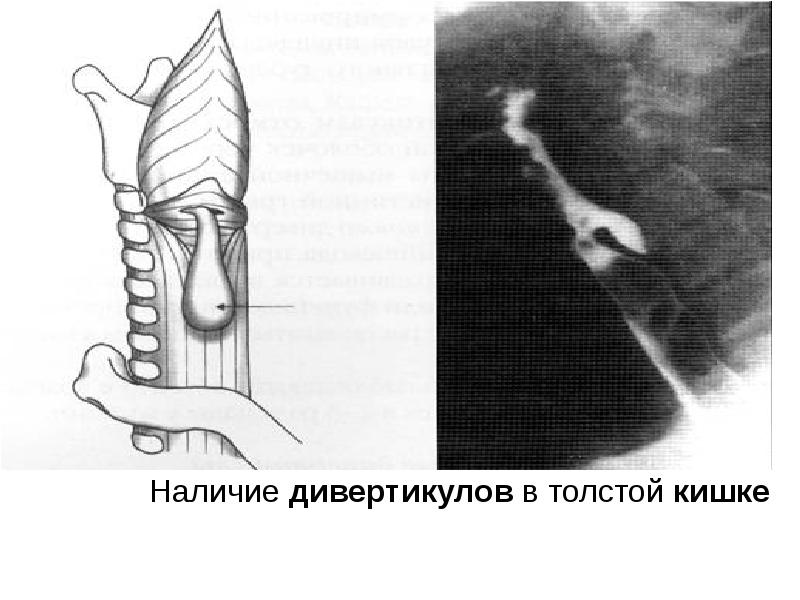 Дивертикул стенки трахеи