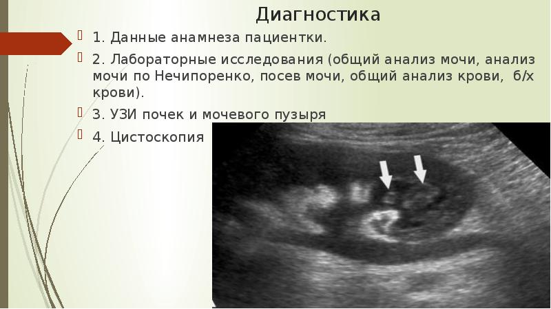 Гломерулонефрит узи картина