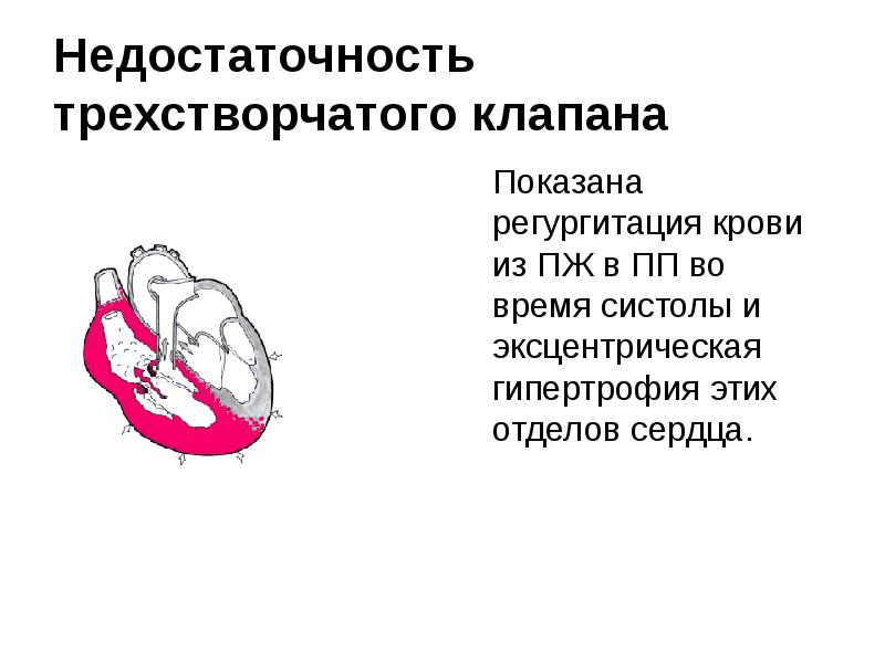 Недостаточность трикуспидального клапана презентация