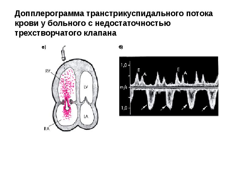 Недостаточность трехстворчатого клапана рисунок