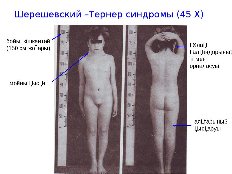 Шерешевский –Тернер синдромы (45 Х) Шерешевский –Тернер синдромы (45 Х)