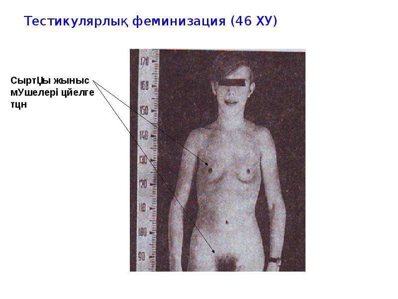 Тестикулярлық феминизация (46 ХУ) Тестикулярлық феминизация (46 ХУ)