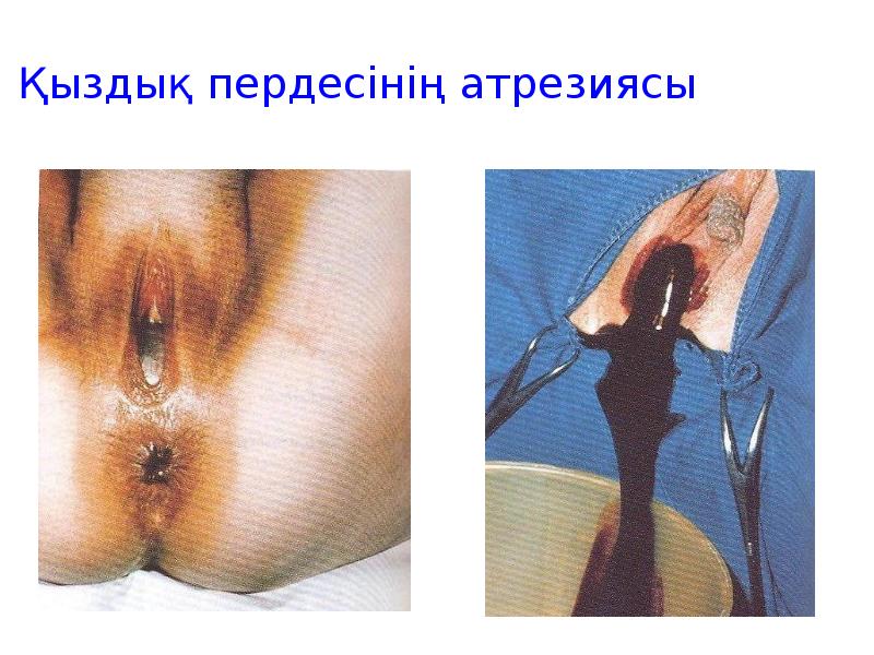 Қыздық пердесінің атрезиясы Қыздық пердесінің атрезиясы