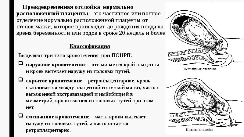 Преждевременная отслойка &nbsp;нормально расположенной плаценты - это частичное или полное отделение