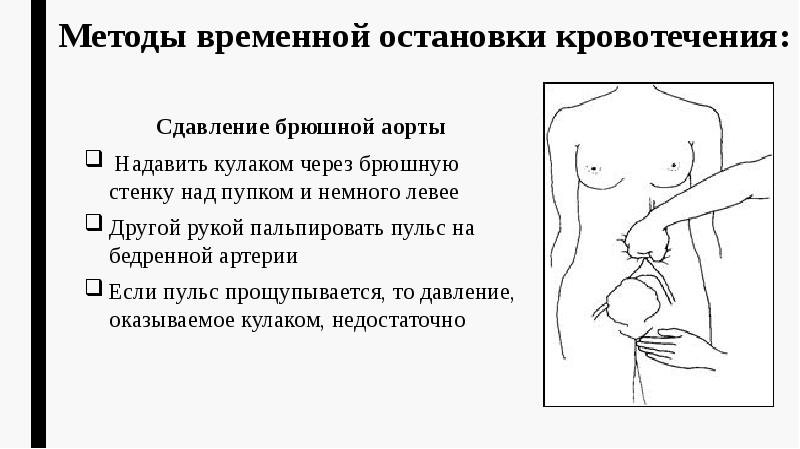 Методы временной остановки кровотечения: Сдавление брюшной аорты  Надавить кулаком через