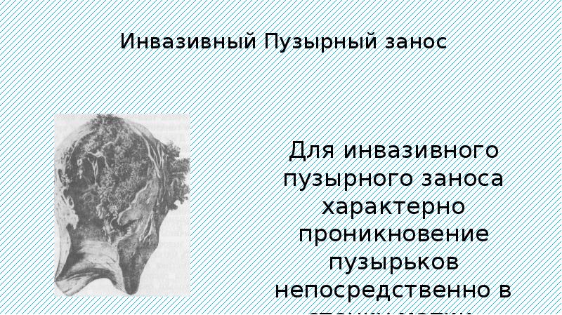 Пузырный занос презентация