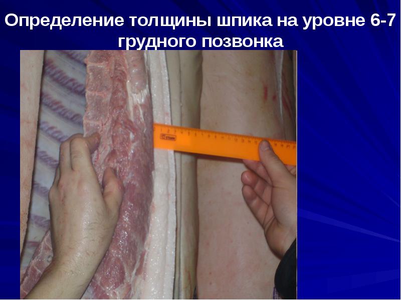 Определение толщины шпика на уровне 6-7 грудного позвонка Определение толщины шпика на уровне 6-7 грудного позвонка