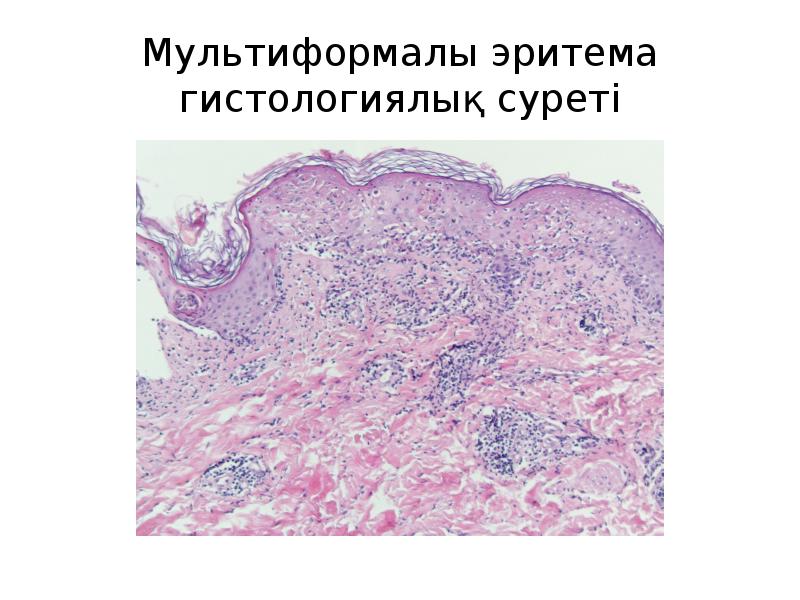 Мультиформалы эритема гистологиялық суреті Мультиформалы эритема гистологиялық суреті