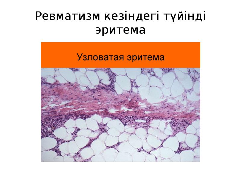 Ревматизм кезіндегі түйінді эритема Ревматизм кезіндегі түйінді эритема