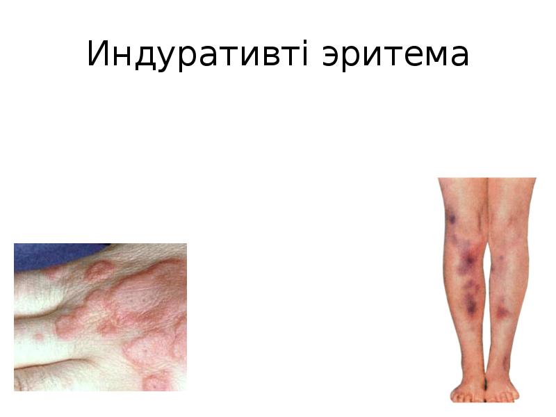 Индуративті эритема Индуративті эритема