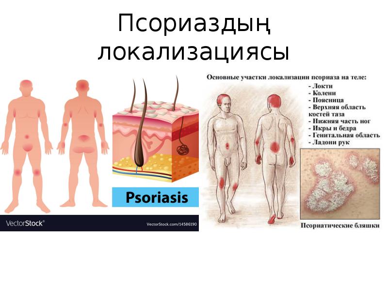 Псориаздың локализациясы Псориаздың локализациясы