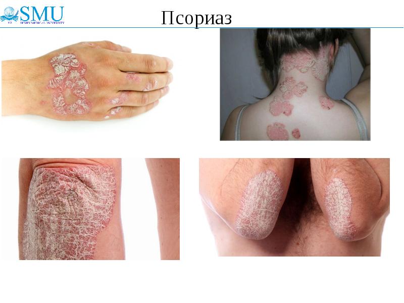 Псориаз Псориаз