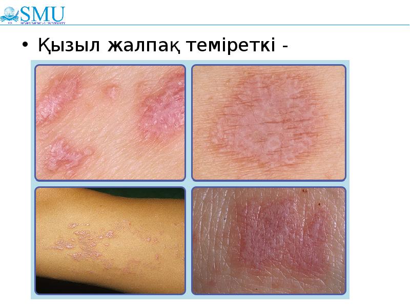 Қызыл жалпақ теміреткі -
Қызыл жалпақ теміреткі - Қызыл жалпақ теміреткі -
Қызыл жалпақ теміреткі -