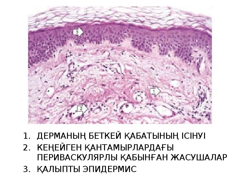 ДЕРМАНЫҢ БЕТКЕЙ ҚАБАТЫНЫҢ ІСІНУІ
КЕҢЕЙГЕН ҚАНТАМЫРЛАРДАҒЫ ПЕРИВАСКУЛЯРЛЫ ҚАБЫНҒАН ЖАСУШАЛАР
ҚАЛЫПТЫ ЭПИДЕРМИС ДЕРМАНЫҢ БЕТКЕЙ ҚАБАТЫНЫҢ ІСІНУІ
КЕҢЕЙГЕН ҚАНТАМЫРЛАРДАҒЫ ПЕРИВАСКУЛЯРЛЫ ҚАБЫНҒАН ЖАСУШАЛАР
ҚАЛЫПТЫ ЭПИДЕРМИС