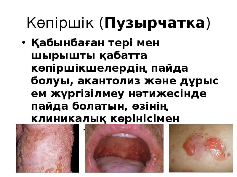 Көпіршік (Пузырчатка)
Қабынбаған тері мен шырышты қабатта көпіршікшелердің пайда болуы, акантолиз Көпіршік (Пузырчатка)
Қабынбаған тері мен шырышты қабатта көпіршікшелердің пайда болуы, акантолиз