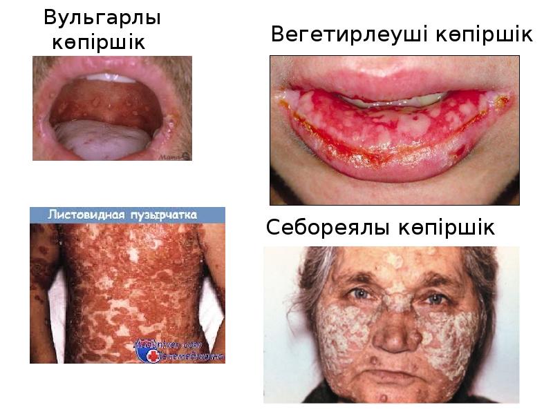 Вульгарлы көпіршік Вульгарлы көпіршік