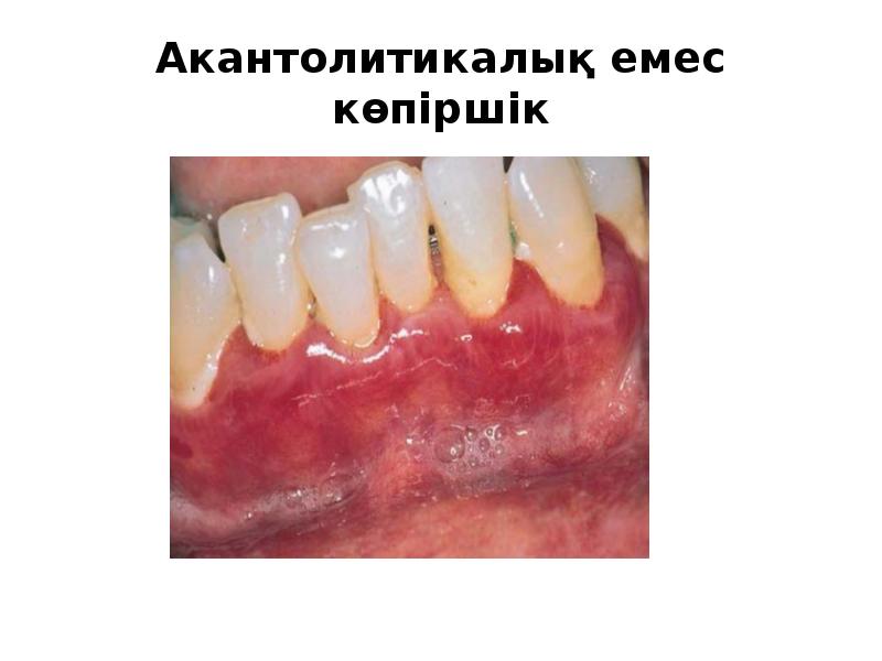 Акантолитикалық емес көпіршік Акантолитикалық емес көпіршік