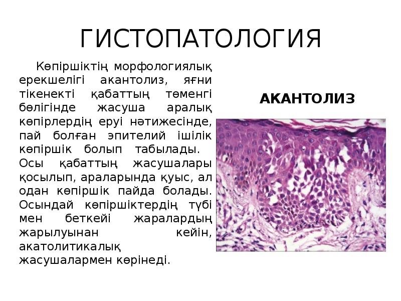 ГИСТОПАТОЛОГИЯ
Көпіршіктің морфологиялық ерекшелігі акантолиз, яғни тікенекті қабаттың төменгі ГИСТОПАТОЛОГИЯ
Көпіршіктің морфологиялық ерекшелігі акантолиз, яғни тікенекті қабаттың төменгі