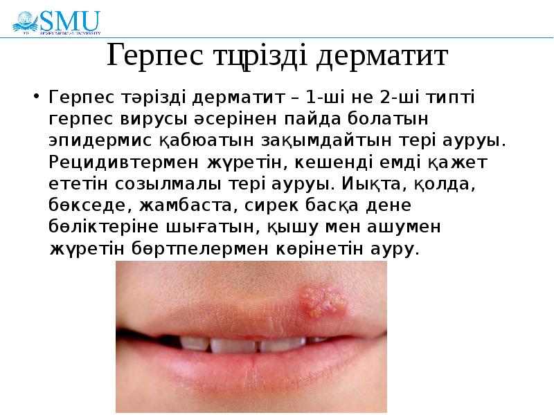 Герпес тәрізді дерматит
Герпес тәрізді дерматит – 1-ші не 2-ші типті Герпес тәрізді дерматит
Герпес тәрізді дерматит – 1-ші не 2-ші типті