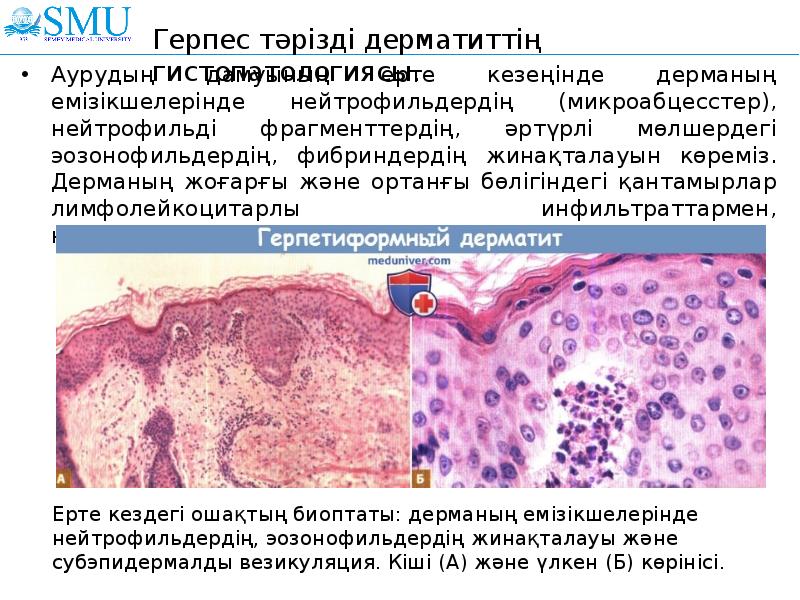Ерте кездегі ошақтың биоптаты: дерманың емізікшелерінде нейтрофильдердің, эозонофильдердің жинақталауы және субэпидермалды