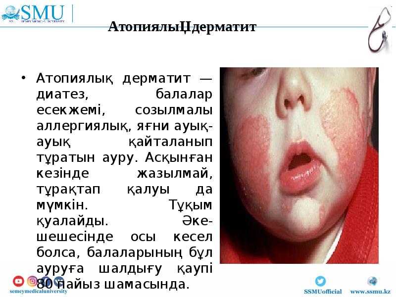 Атопиялық дерматит — диатез, балалар есекжемі, созылмалы аллергиялық, яғни ауық-ауық қайталанып Атопиялық дерматит — диатез, балалар есекжемі, созылмалы аллергиялық, яғни ауық-ауық қайталанып