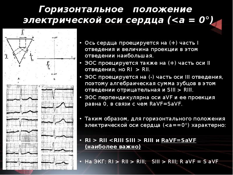 Отклонение правой электрической оси