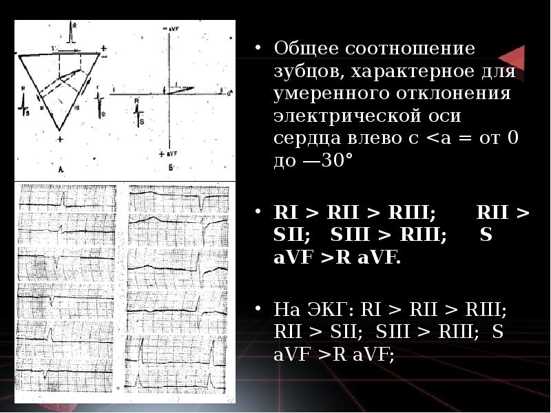 Общее соотношение зубцов, характерное для умеренного отклонения электрической оси сердца влево Общее соотношение зубцов, характерное для умеренного отклонения электрической оси сердца влево