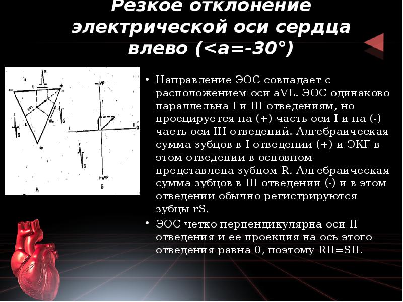 Резкое отклонение электрической оси сердца влево (<а=-30°)
Направление ЭОС совпадает Резкое отклонение электрической оси сердца влево (<а=-30°)
Направление ЭОС совпадает