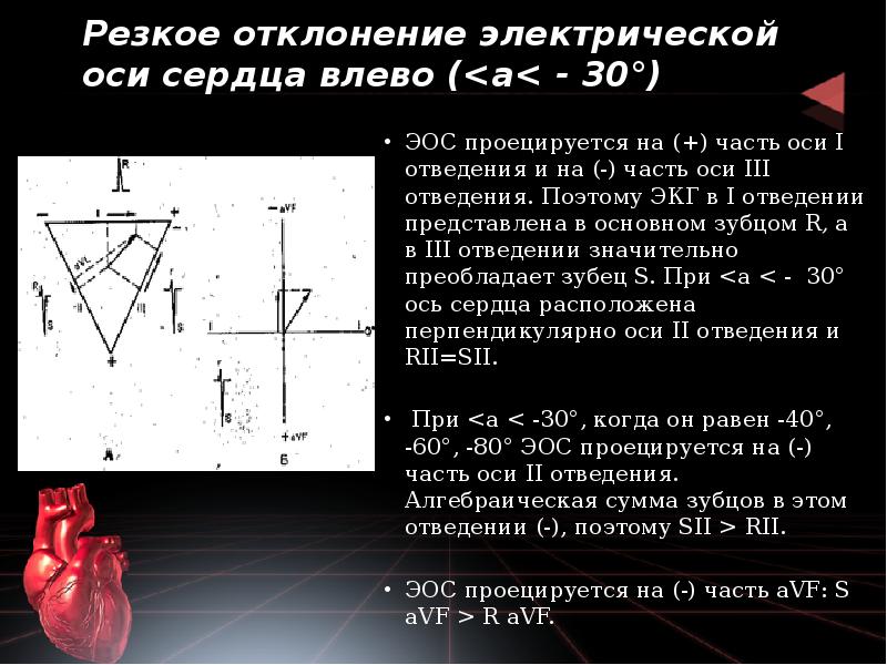 Электрическая ось резко влево