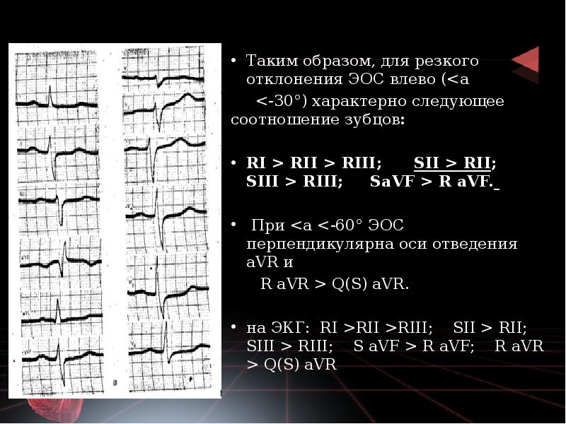 Эос экг что значит. Отклонение ЭОС влево на ЭКГ. Электрическая ось влево на ЭКГ. Смещение электрической оси сердца влево на ЭКГ. Отклонение электрической оси сердца на ЭКГ.