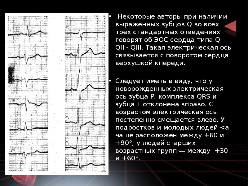 Некоторые авторы при наличии выраженных зубцов Q во всех трех стандартных