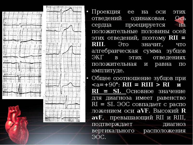 Проекция ее на оси этих отведений одинаковая. Ось сердца проецируется на Проекция ее на оси этих отведений одинаковая. Ось сердца проецируется на