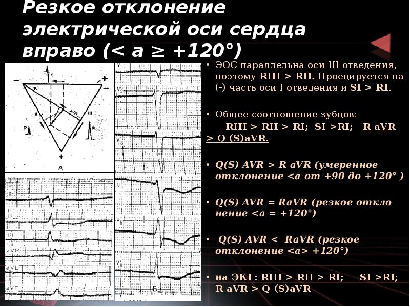 Резкое отклонение электрической оси сердца вправо (< а ≥ +120°)
ЭОС Резкое отклонение электрической оси сердца вправо (< а ≥ +120°)
ЭОС